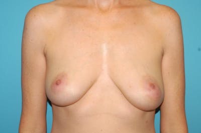 Mastopexy Before & After Gallery - Patient 8795428 - Image 1