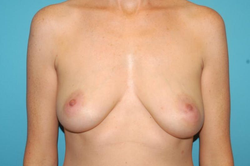 Mastopexy Before & After Gallery - Patient 8795428 - Image 1