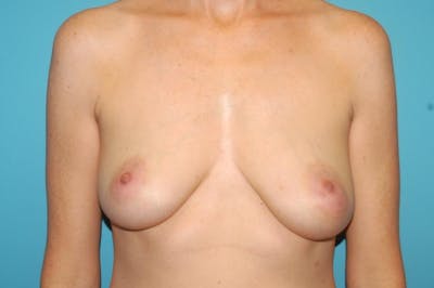 Mastopexy Before & After Gallery - Patient 8795428 - Image 1