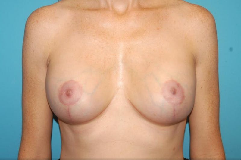 Mastopexy Before & After Gallery - Patient 8795428 - Image 2