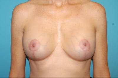 Mastopexy Before & After Gallery - Patient 8795428 - Image 2