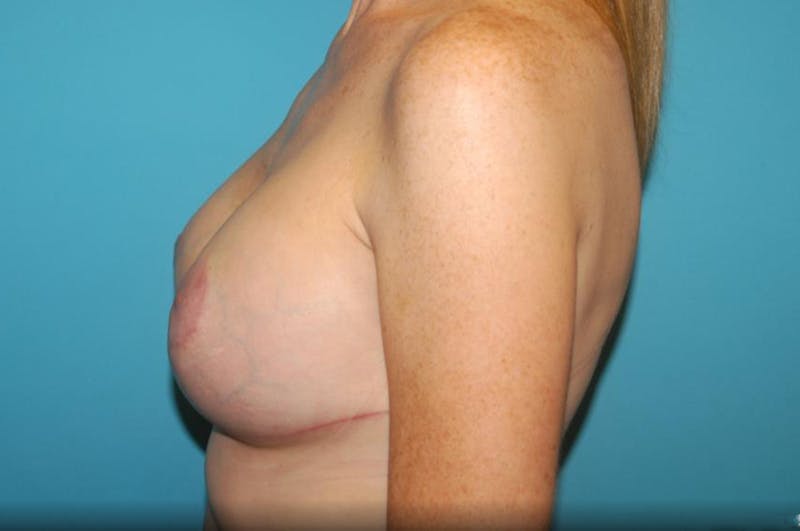 Mastopexy Before & After Gallery - Patient 8795428 - Image 4