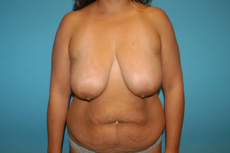 Liposuction Before & After Gallery - Patient 8795429 - Image 1