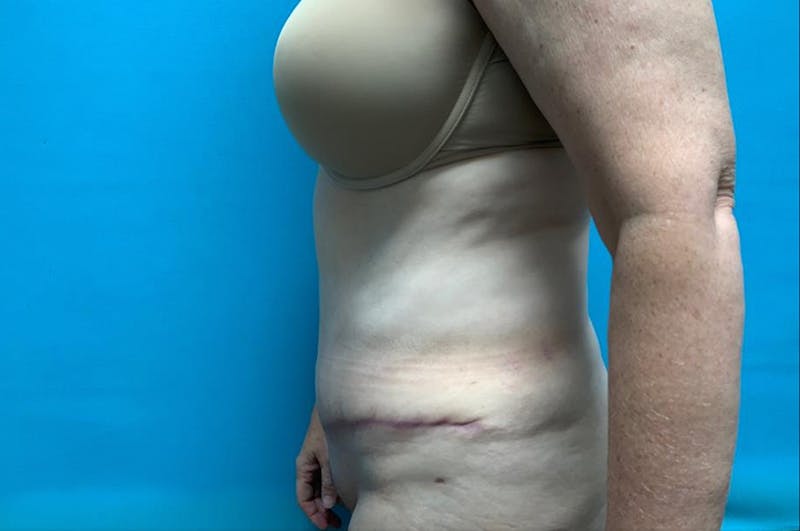 Abdominoplasty Before & After Gallery - Patient 8795427 - Image 6