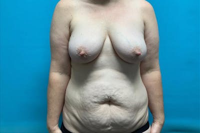 Mastopexy Before & After Gallery - Patient 8795432 - Image 1