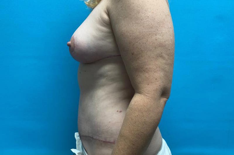 Mastopexy Before & After Gallery - Patient 8795432 - Image 6