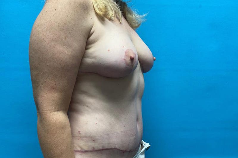 Abdominoplasty Before & After Gallery - Patient 8795434 - Image 4