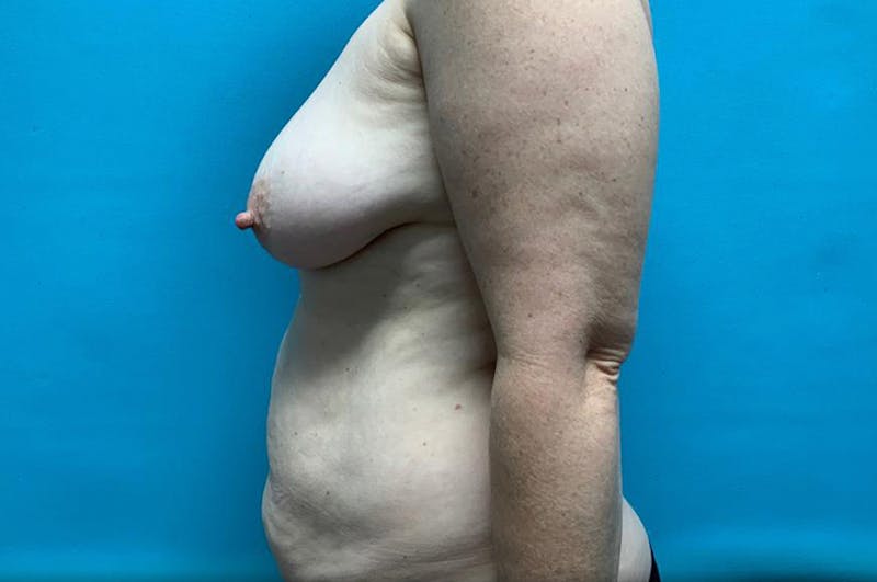 Abdominoplasty Before & After Gallery - Patient 8795434 - Image 5