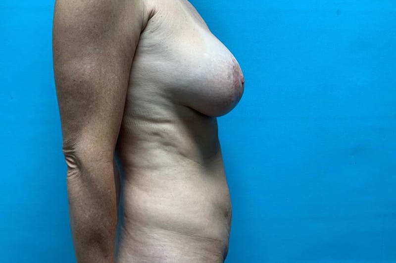 Mastopexy Before & After Gallery - Patient 8795435 - Image 3