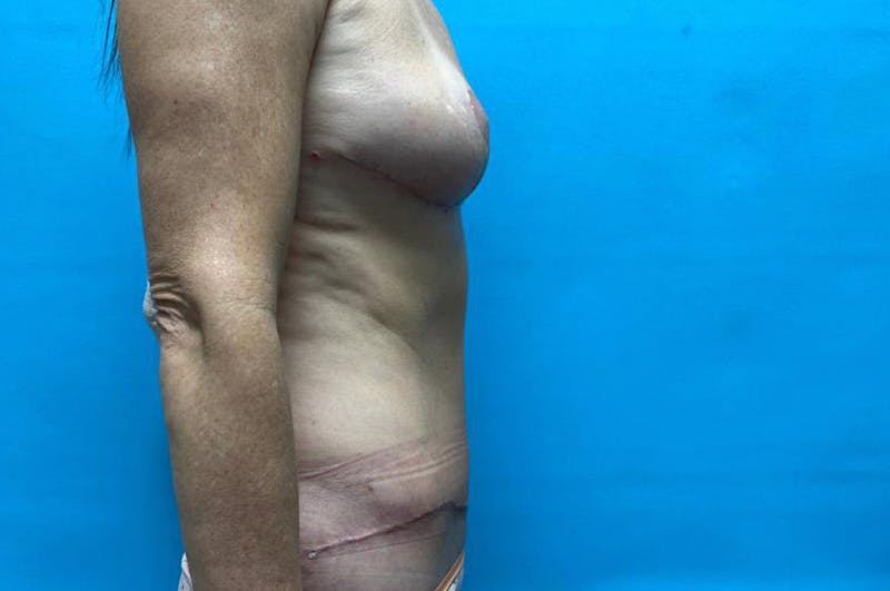 Mastopexy Before & After Gallery - Patient 8795435 - Image 4