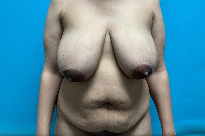 Mastopexy Before & After Gallery - Patient 8795438 - Image 1