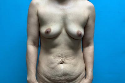 Mastopexy Before & After Gallery - Patient 8795441 - Image 1