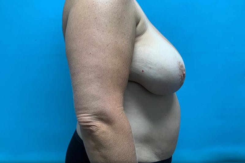 Abdominoplasty Before & After Gallery - Patient 8795440 - Image 5