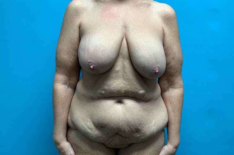 Abdominoplasty Before & After Gallery - Patient 8795447 - Image 1