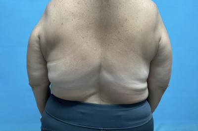Liposuction Before & After Gallery - Patient 8795446 - Image 2