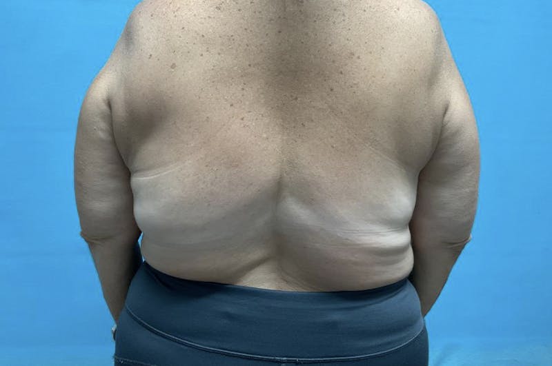 Liposuction Before & After Gallery - Patient 8795446 - Image 2