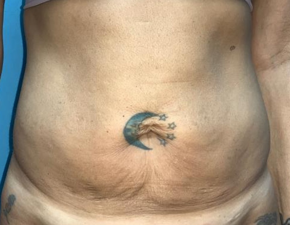 A Better Belly Button: Neo-Umbilicus Technique - Stephens Plastic Surgery