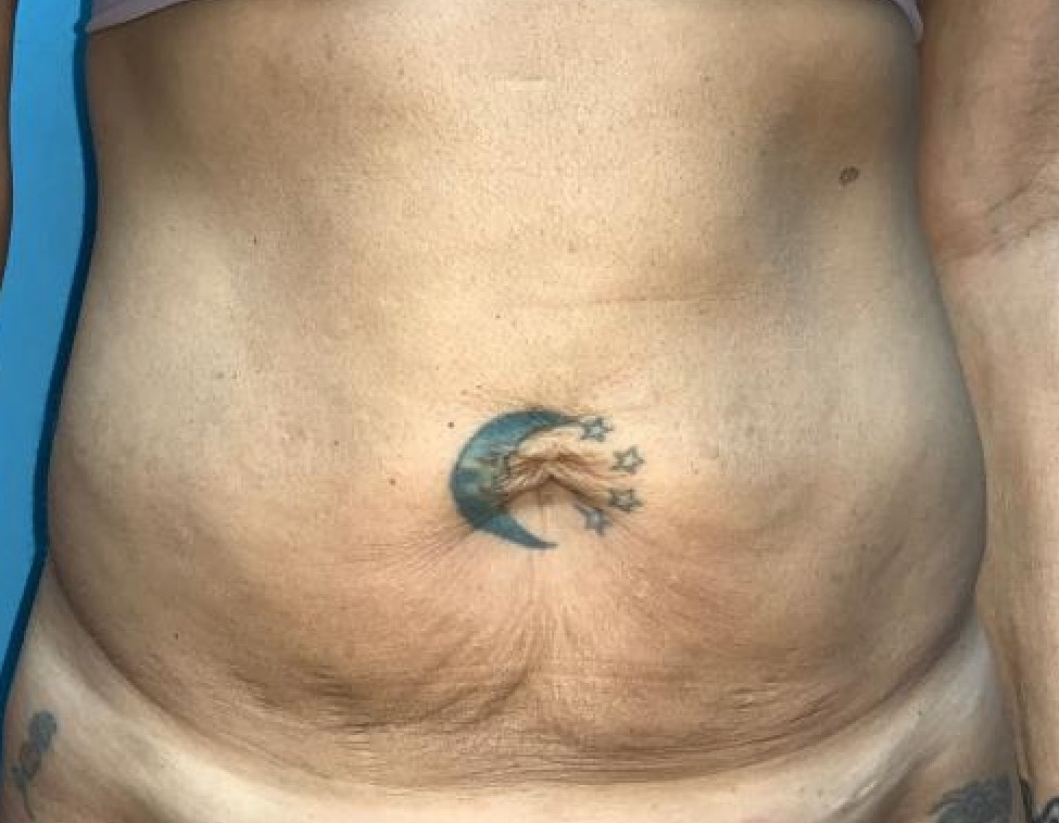 Dr. Zuckerman's Techniques to Achieve the Best Tummy Tuck Surgery