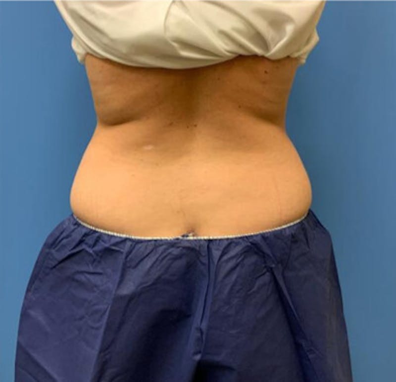 CoolSculpting Before & After Gallery - Patient 29408604 - Image 2