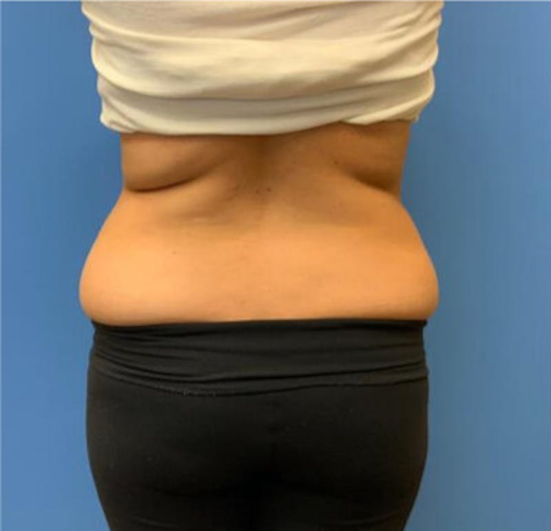 CoolSculpting Before & After Gallery - Patient 29408604 - Image 1