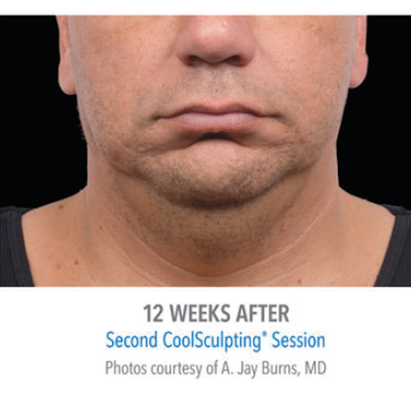 CoolSculpting Before & After Gallery - Patient 29408605 - Image 2