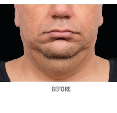 CoolSculpting Before & After Gallery - Patient 29408605 - Image 1