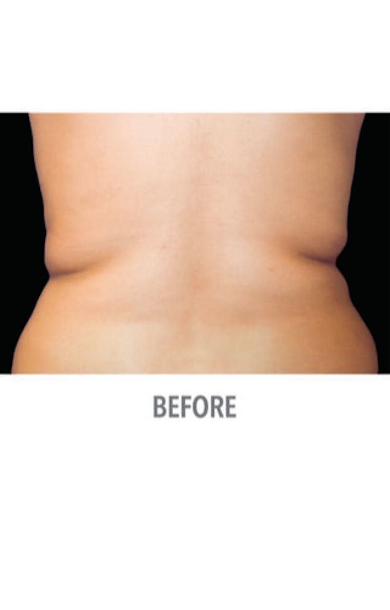 CoolSculpting Before & After Gallery - Patient 29408606 - Image 1