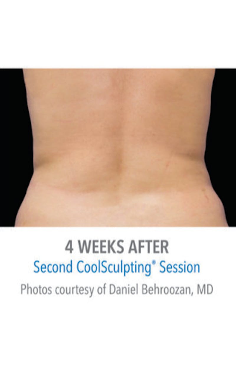 CoolSculpting Before & After Gallery - Patient 29408606 - Image 2