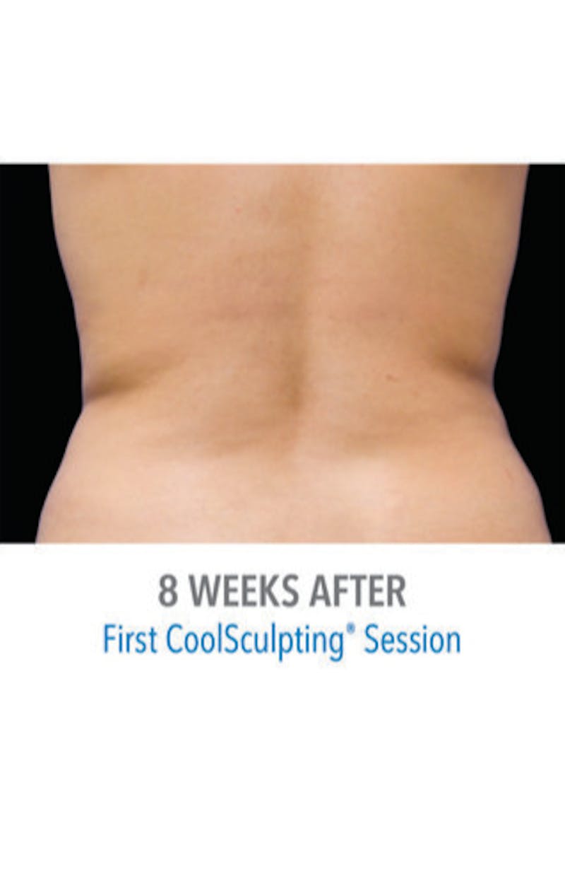 CoolSculpting Before & After Gallery - Patient 29408606 - Image 4