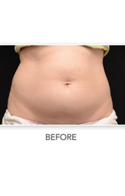 CoolSculpting Before & After Gallery - Patient 29408608 - Image 1