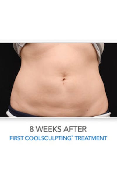 CoolSculpting Before & After Gallery - Patient 29408608 - Image 2