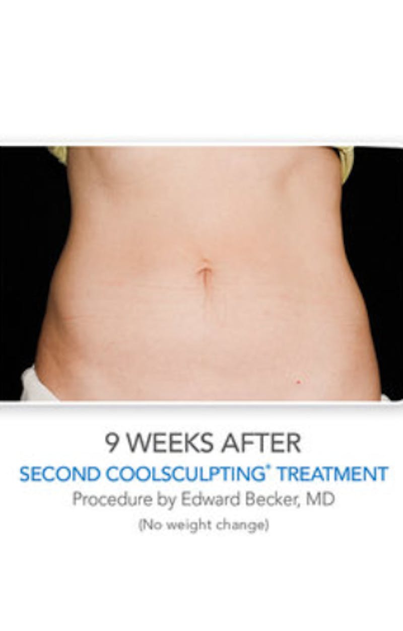 CoolSculpting Before & After Gallery - Patient 29408608 - Image 4