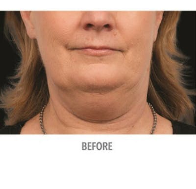 CoolSculpting Before & After Gallery - Patient 29408609 - Image 1