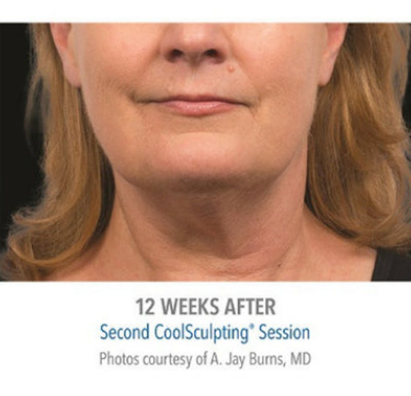 CoolSculpting Before & After Gallery - Patient 29408609 - Image 2
