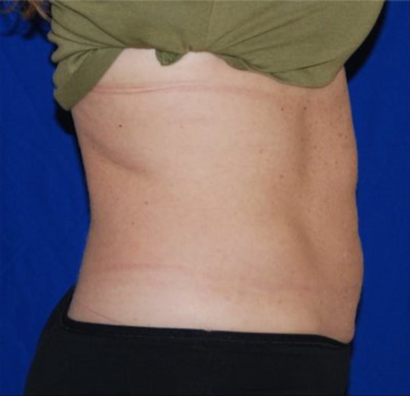 CoolSculpting Before & After Gallery - Patient 29408610 - Image 1