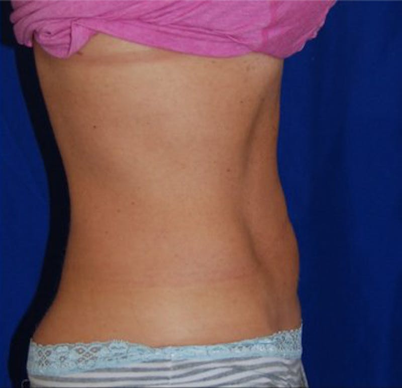 CoolSculpting Before & After Gallery - Patient 29408610 - Image 2