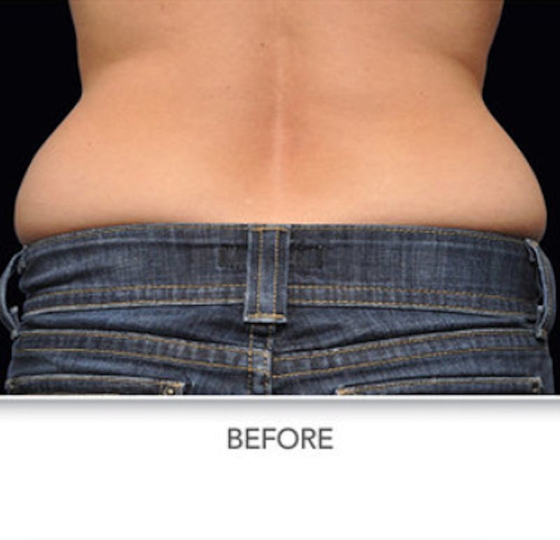 CoolSculpting Before & After Gallery - Patient 29408611 - Image 1
