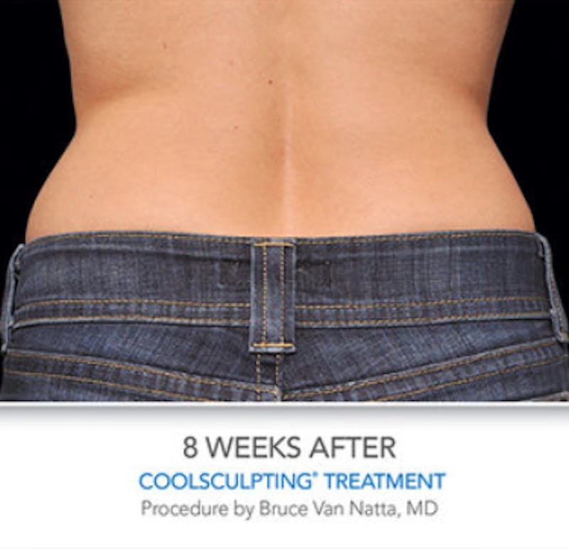 CoolSculpting Before & After Gallery - Patient 29408611 - Image 2