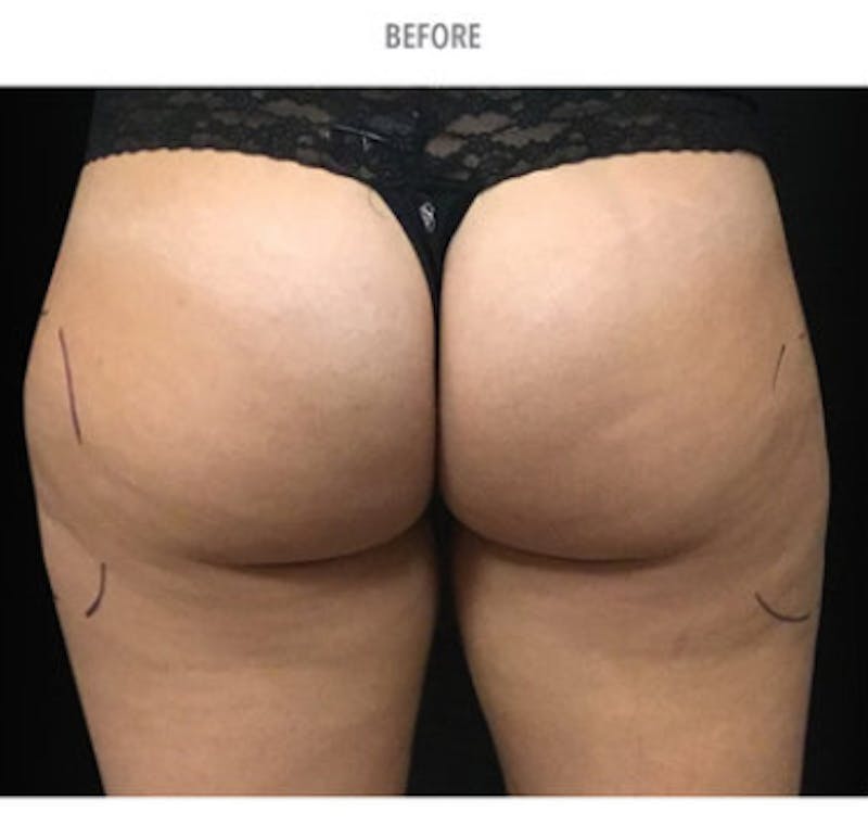 CoolSculpting Before & After Gallery - Patient 29408612 - Image 1