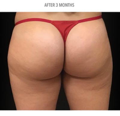 CoolSculpting Before & After Gallery - Patient 29408612 - Image 2