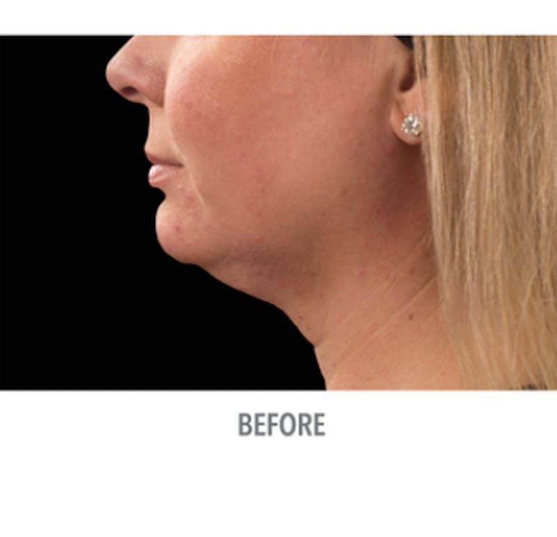 CoolSculpting Before & After Gallery - Patient 29408613 - Image 1