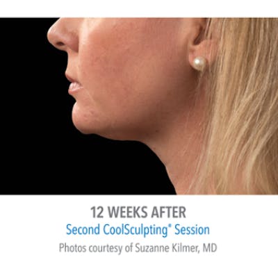 CoolSculpting Before & After Gallery - Patient 29408613 - Image 2
