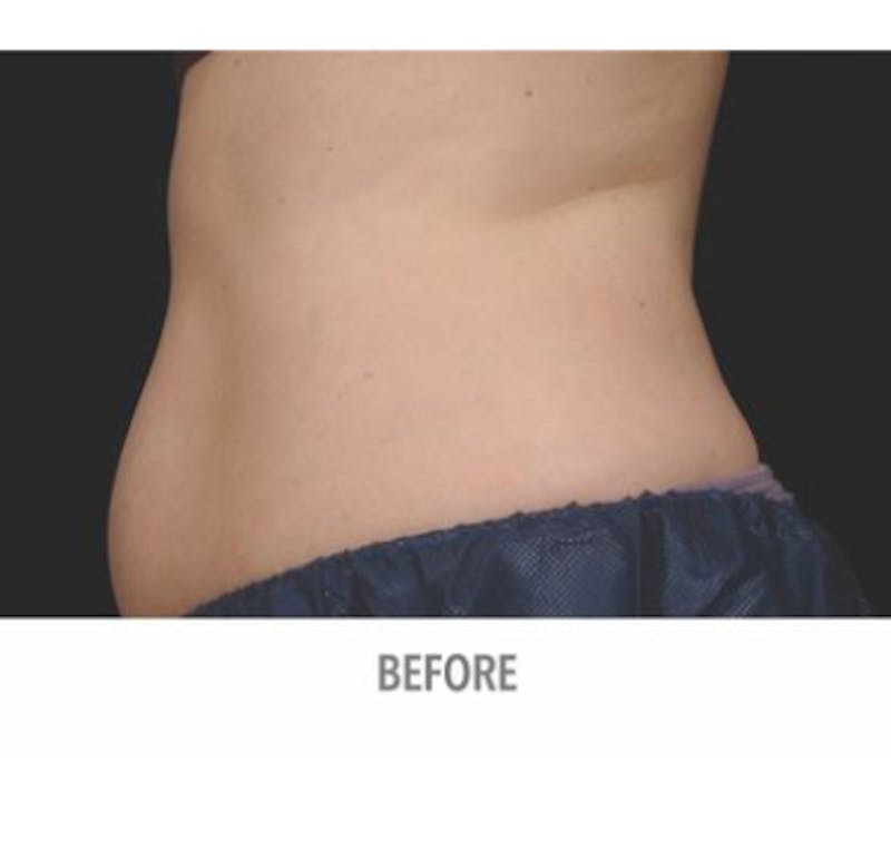 CoolSculpting Before & After Gallery - Patient 29408614 - Image 1