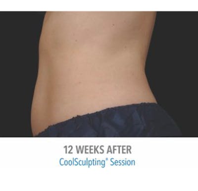 CoolSculpting Before & After Gallery - Patient 29408614 - Image 2