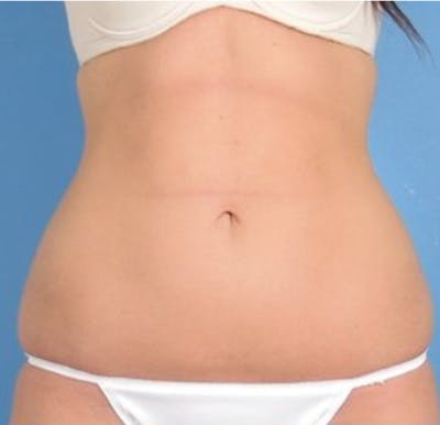 CoolSculpting Before & After Gallery - Patient 29408615 - Image 1
