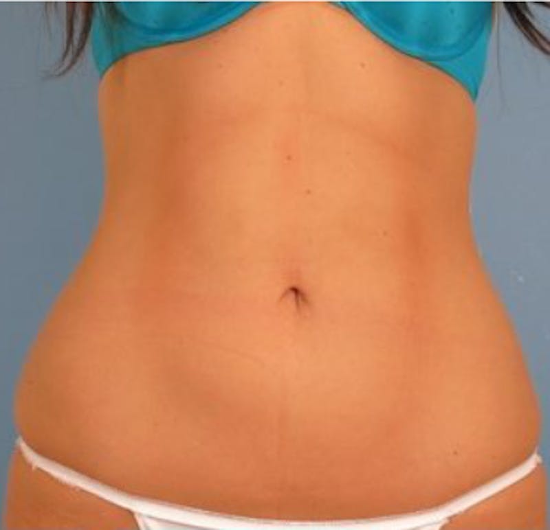 CoolSculpting Before & After Gallery - Patient 29408615 - Image 2