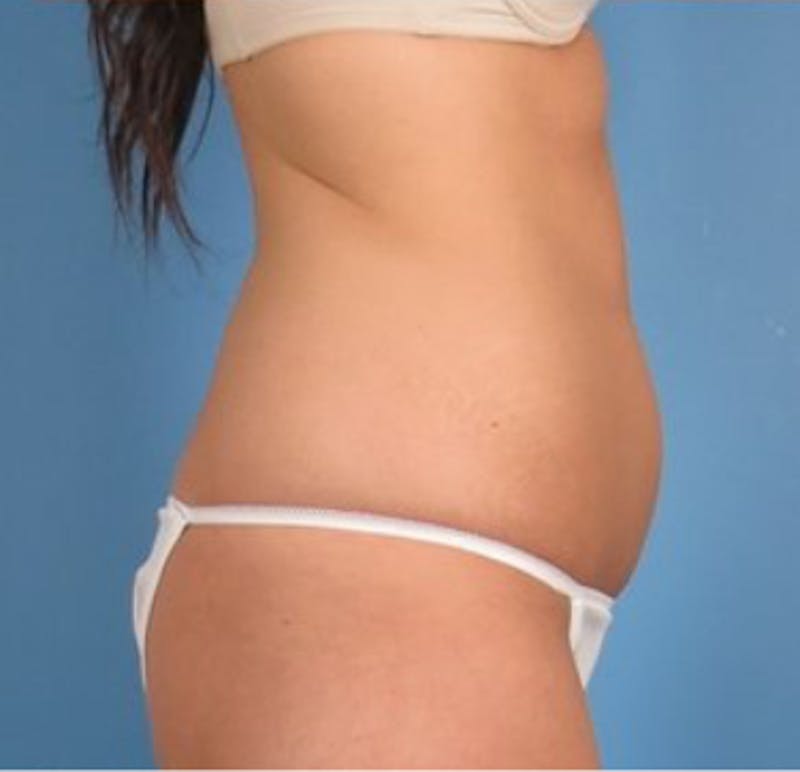 CoolSculpting Before & After Gallery - Patient 29408615 - Image 3