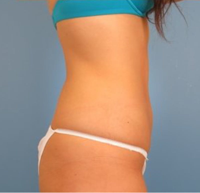 CoolSculpting Before & After Gallery - Patient 29408615 - Image 4