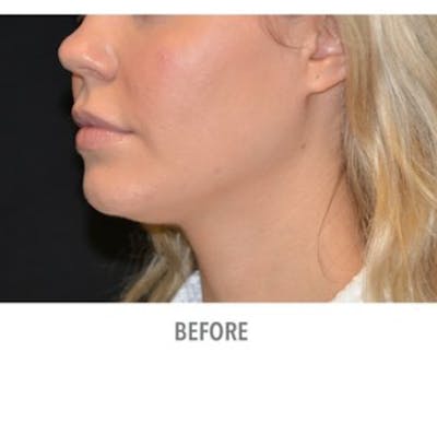 CoolSculpting Before & After Gallery - Patient 29408616 - Image 1