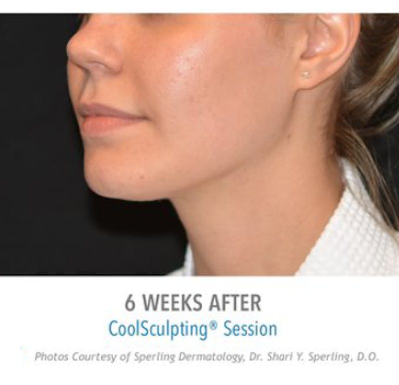 CoolSculpting Before & After Gallery - Patient 29408616 - Image 2